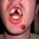 man with tooth missing
