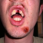 man with tooth missing