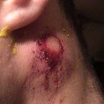 paintball injury 1