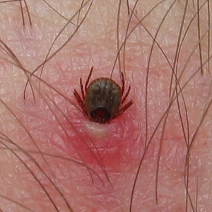 how to remove a human tick
