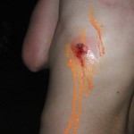 paintball injury 2